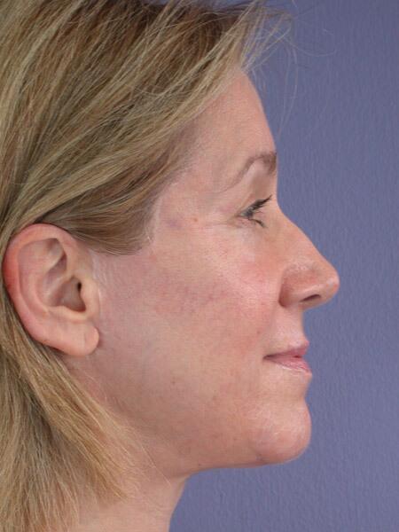 Laser Skin Resurfacing Before & After Image