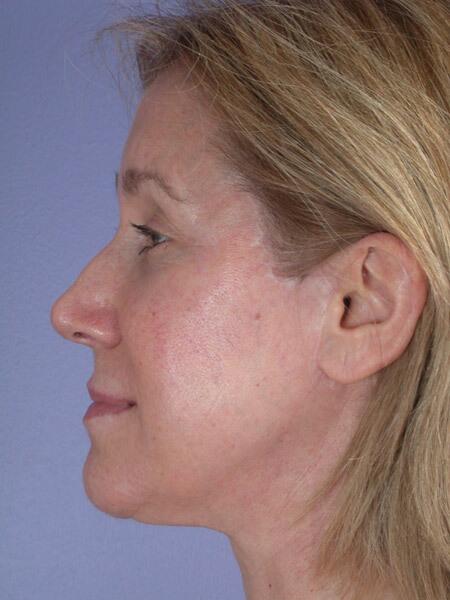 Laser Skin Resurfacing Before & After Image