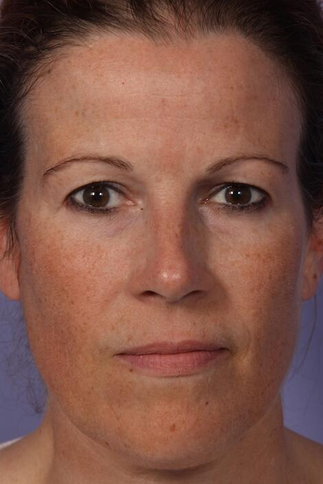Limelight Before & After Image
