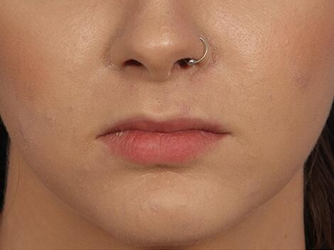 Lip Augmentation Before & After Image