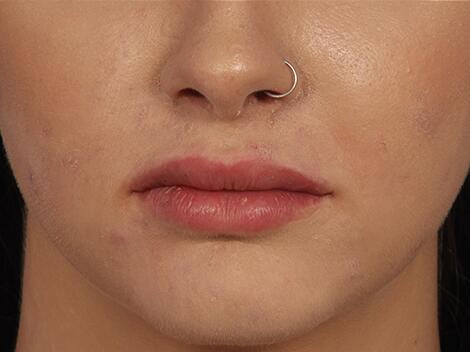 Lip Augmentation Before & After Image