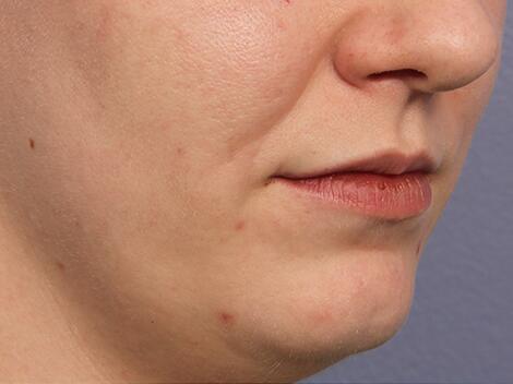 Lip Augmentation Before & After Image