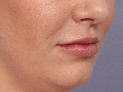 Lip Augmentation Before & After Image