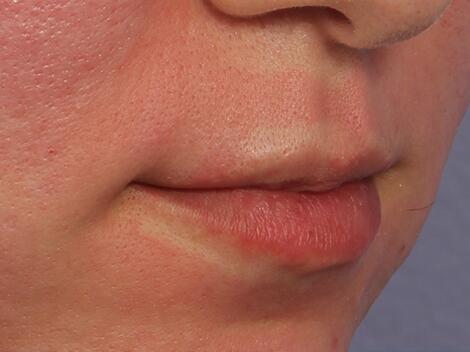 Lip Augmentation Before & After Image