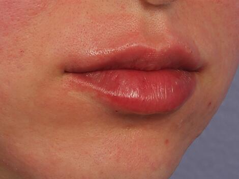 Lip Augmentation Before & After Image