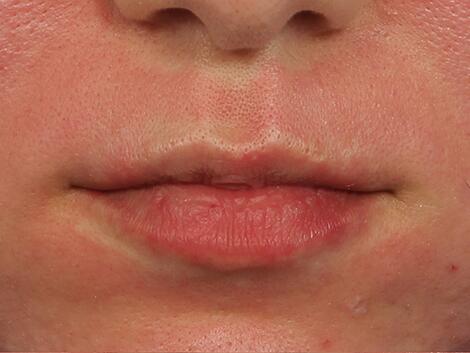 Lip Augmentation Before & After Image