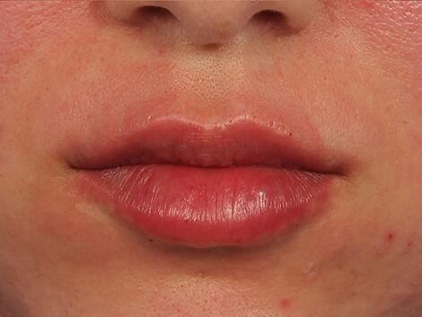 Lip Augmentation Before & After Image