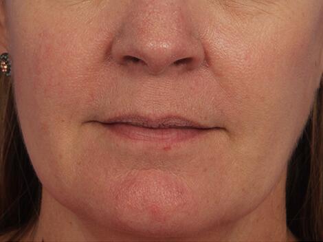 Lip Augmentation Before & After Image