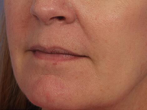 Lip Augmentation Before & After Image