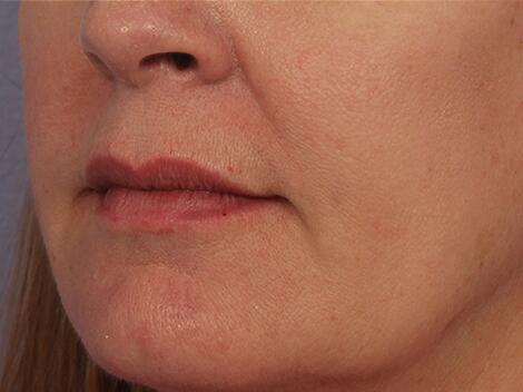 Lip Augmentation Before & After Image