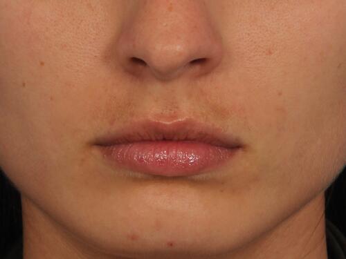 Lip Augmentation Before & After Image