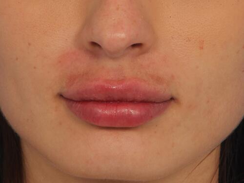 Lip Augmentation Before & After Image