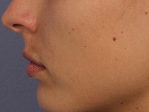 Lip Augmentation Before & After Image