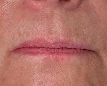 Lip Augmentation Before & After Image