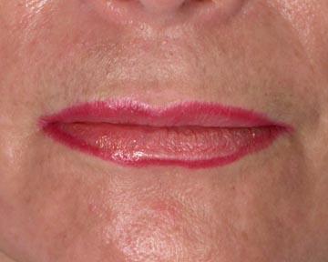 Lip Augmentation Before & After Image