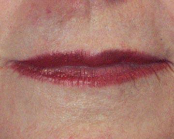 Lip Augmentation Before & After Image