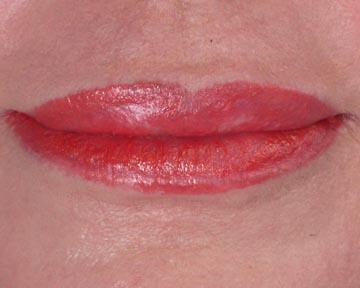 Lip Augmentation Before & After Image