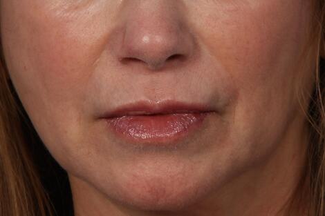 Lip Augmentation Before & After Image