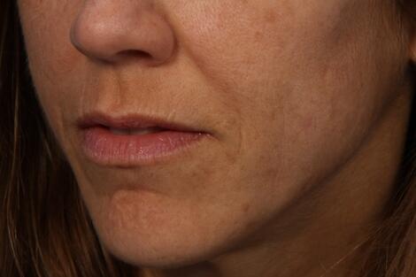 Lip Augmentation Before & After Image