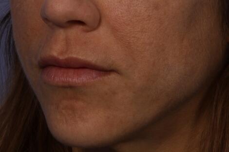 Lip Augmentation Before & After Image
