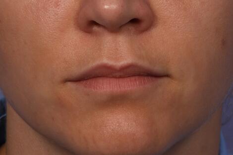 Lip Augmentation Before & After Image