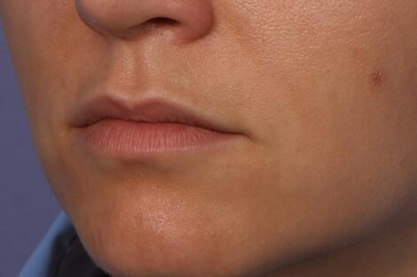 Lip Augmentation Before & After Image