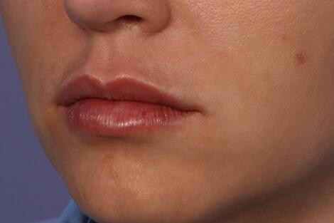 Lip Augmentation Before & After Image