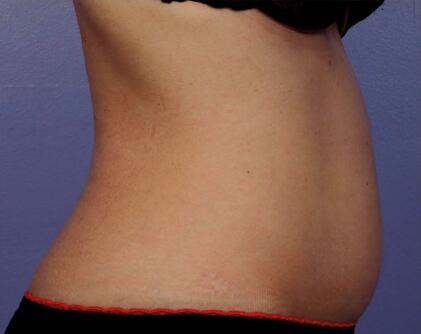 Liposonix® Before & After Image