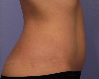 Liposonix® Before & After Image