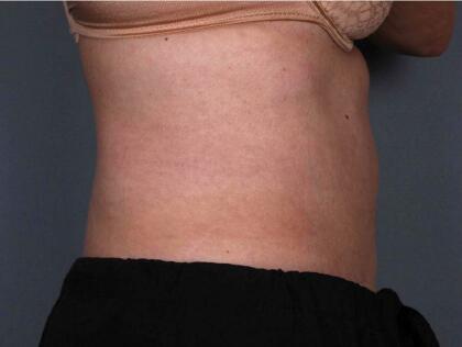 Liposonix® Before & After Image