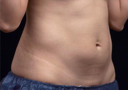 Liposonix® Before & After Image