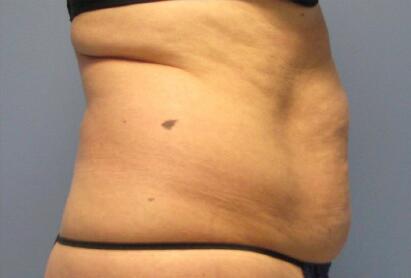 Liposonix® Before & After Image