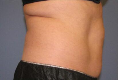 Liposonix® Before & After Image