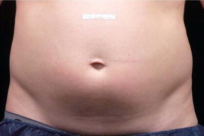 Liposonix® Before & After Image