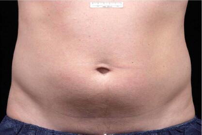 Liposonix® Before & After Image