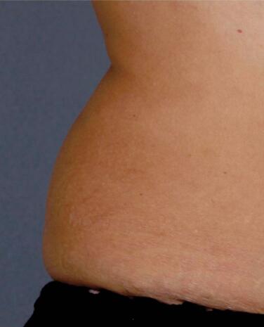 Liposonix® Before & After Image