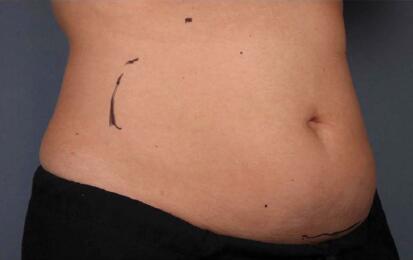 Liposonix® Before & After Image