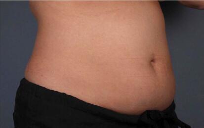 Liposonix® Before & After Image