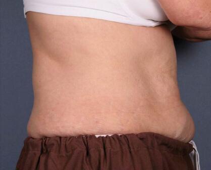 Liposonix® Before & After Image