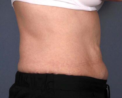 Liposonix® Before & After Image