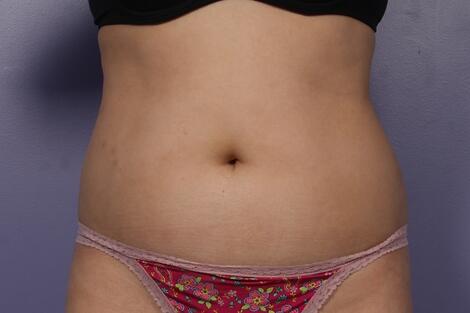 Liposonix® Before & After Image