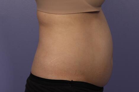 Liposonix® Before & After Image