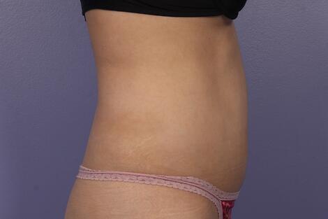 Liposonix® Before & After Image