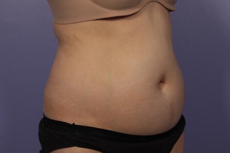 Liposonix® Before & After Image