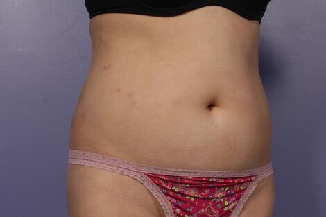 Liposonix® Before & After Image