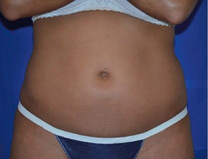 Liposonix® Before & After Image