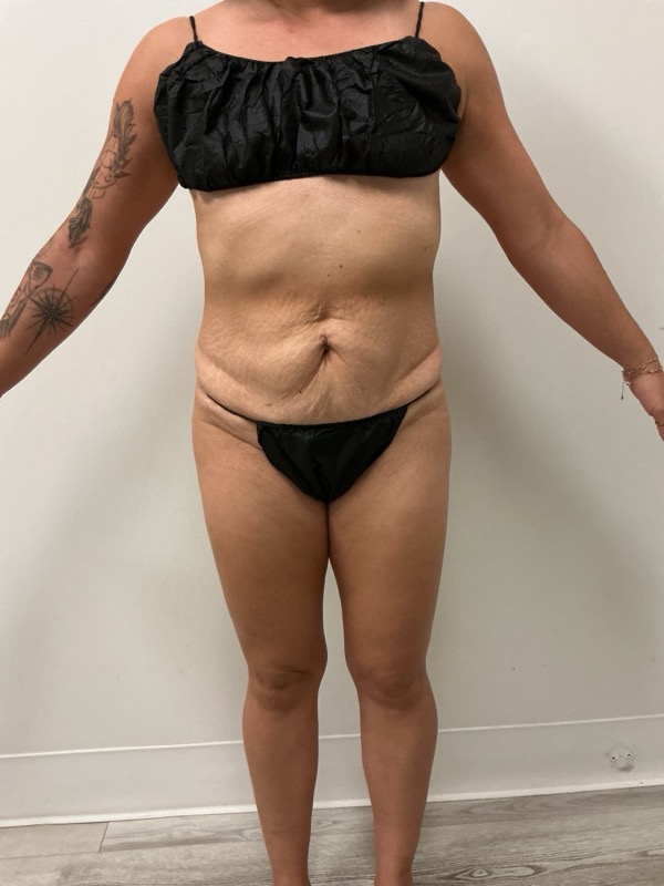Liposuction - Dr. Obi Before & After Image