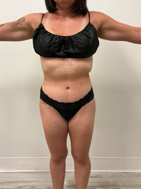 Liposuction - Dr. Obi Before & After Image