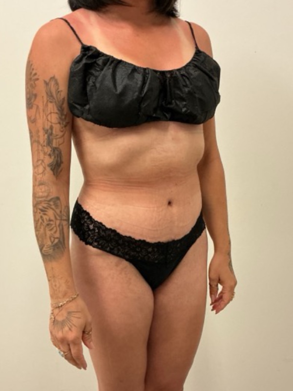 Liposuction - Dr. Obi Before & After Image