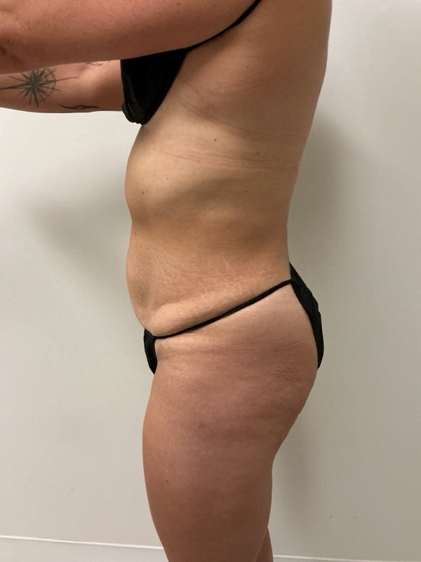 Liposuction - Dr. Obi Before & After Image